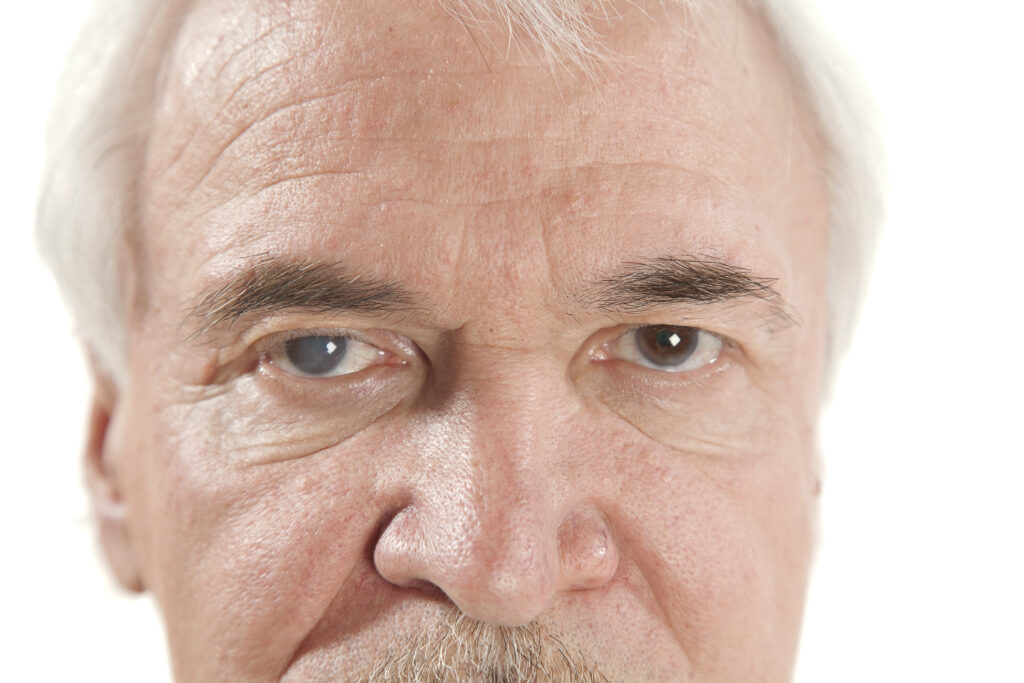 Close up image of the head of a senior white man with white hair and brown eyes. The pupil of one eye is graying, showing signs of glaucoma